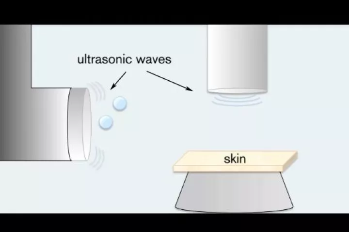 A basic diagram of MIT's painless drug delivery system