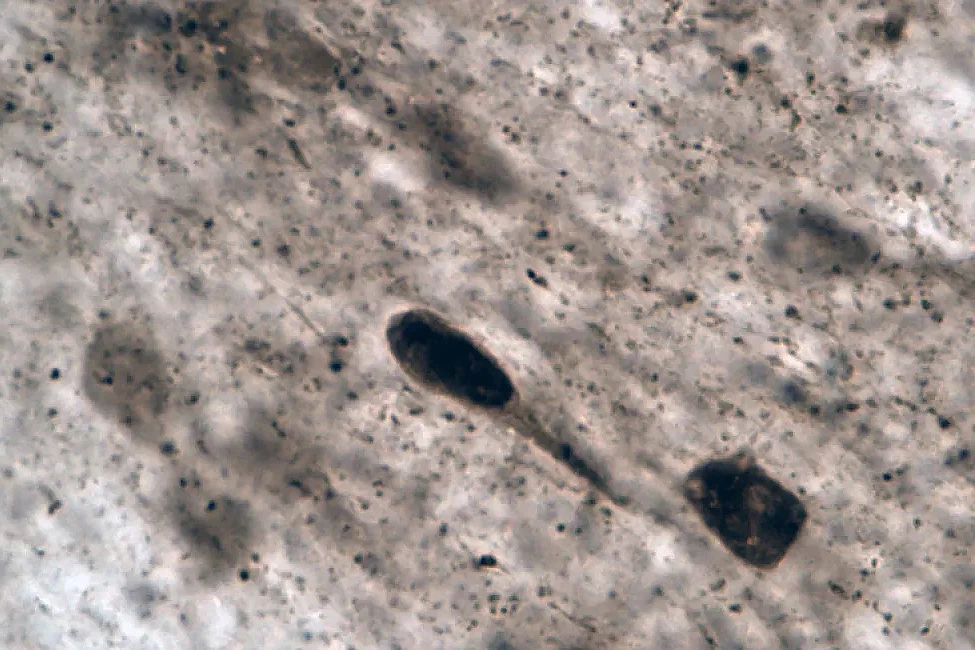 Aggregation of alpha-synuclein (alpha-syn), seen here as the darker matter, in a nerve cell