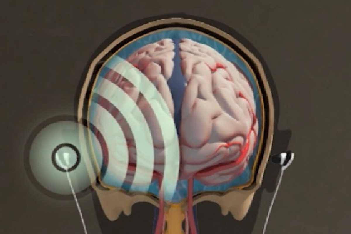 Earbuds could provide sound alternative to holes in the head