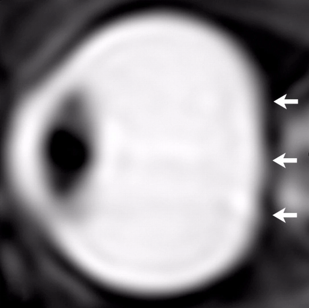 From a study of astronauts in 2012, sagittal oblique T2-weighted MR image of left eye after long-term exposure to microgravity
