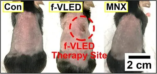 In lab tests, the device was tested on the shaved backs of mice