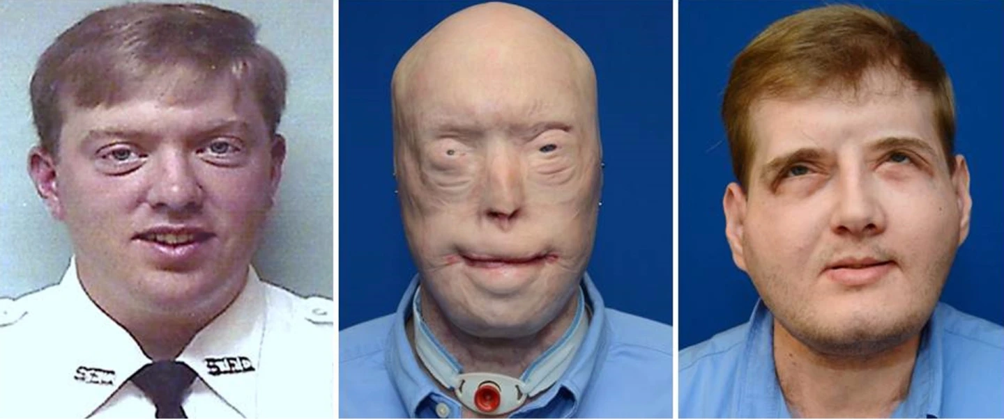 Hardison before and after his accident and transplant