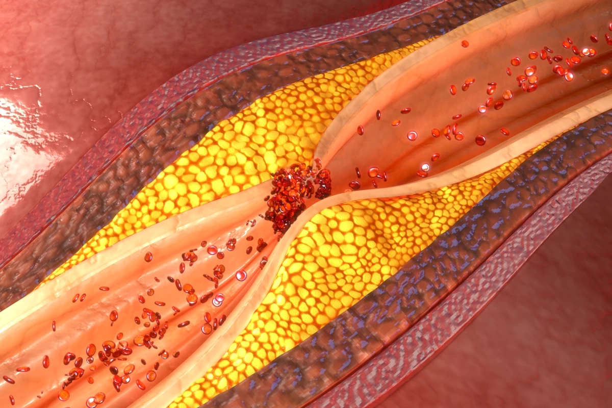 Researchers have discovered a protein that could be targeted to prevent plaque buildup in arteries