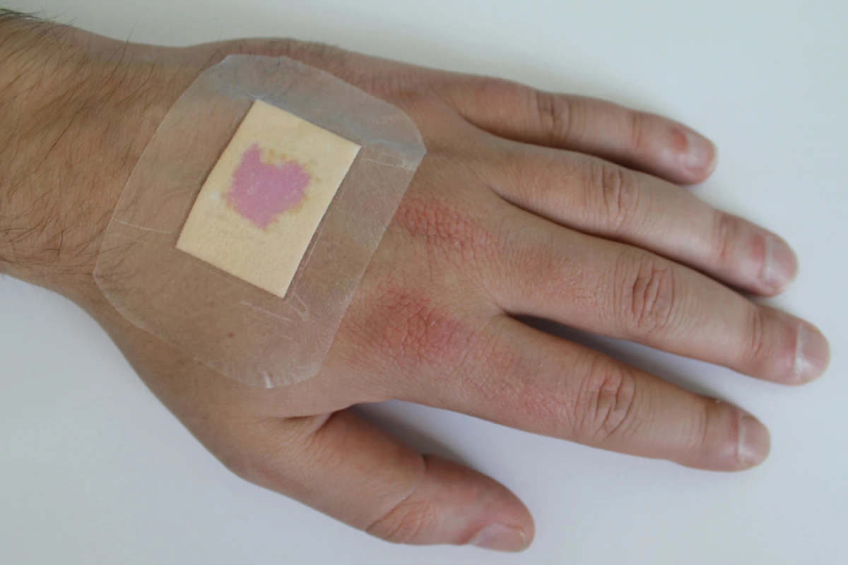 The new dressing material indicates infection by turning purple (Image: Fraunhofer EMFT)