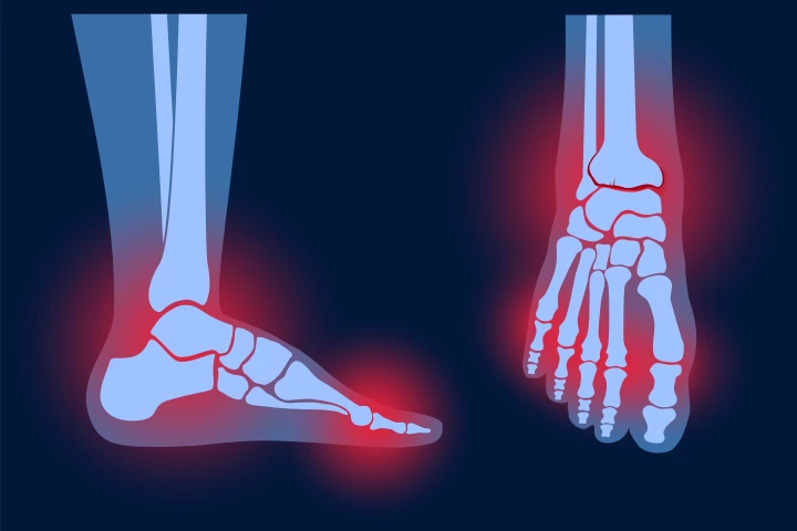 New research speculates immune antibodies targeting a gut bacteria protein could play a role in the development of rheumatoid arthritis