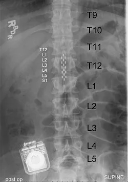 Implanted electrode array (Image: The Lancet)