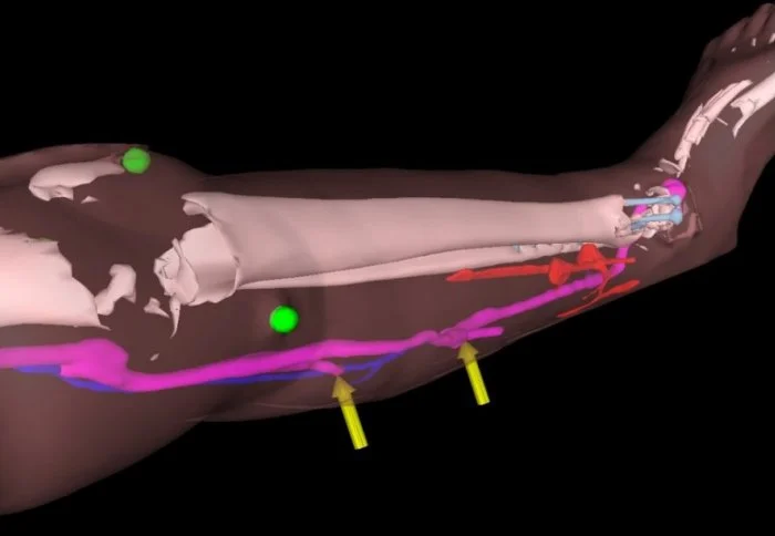 A view of a patient's leg, with the CT scan image overlaid