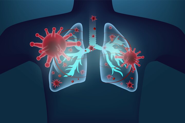 Research indicates newer COVID variants stemming from BA.2.86 can infect the lungs more effectively than any variant since Delta