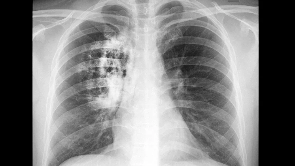 Findings that a variant of the CIZ1 protein is present in lung cancers could lead to the development of a blood test for the disease (Image: Shutterstock)