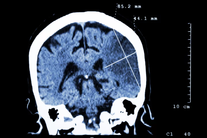 A drug already used to treat certain conditions in humans can not only limit the effects of stroke, but also help repair the damage they cause