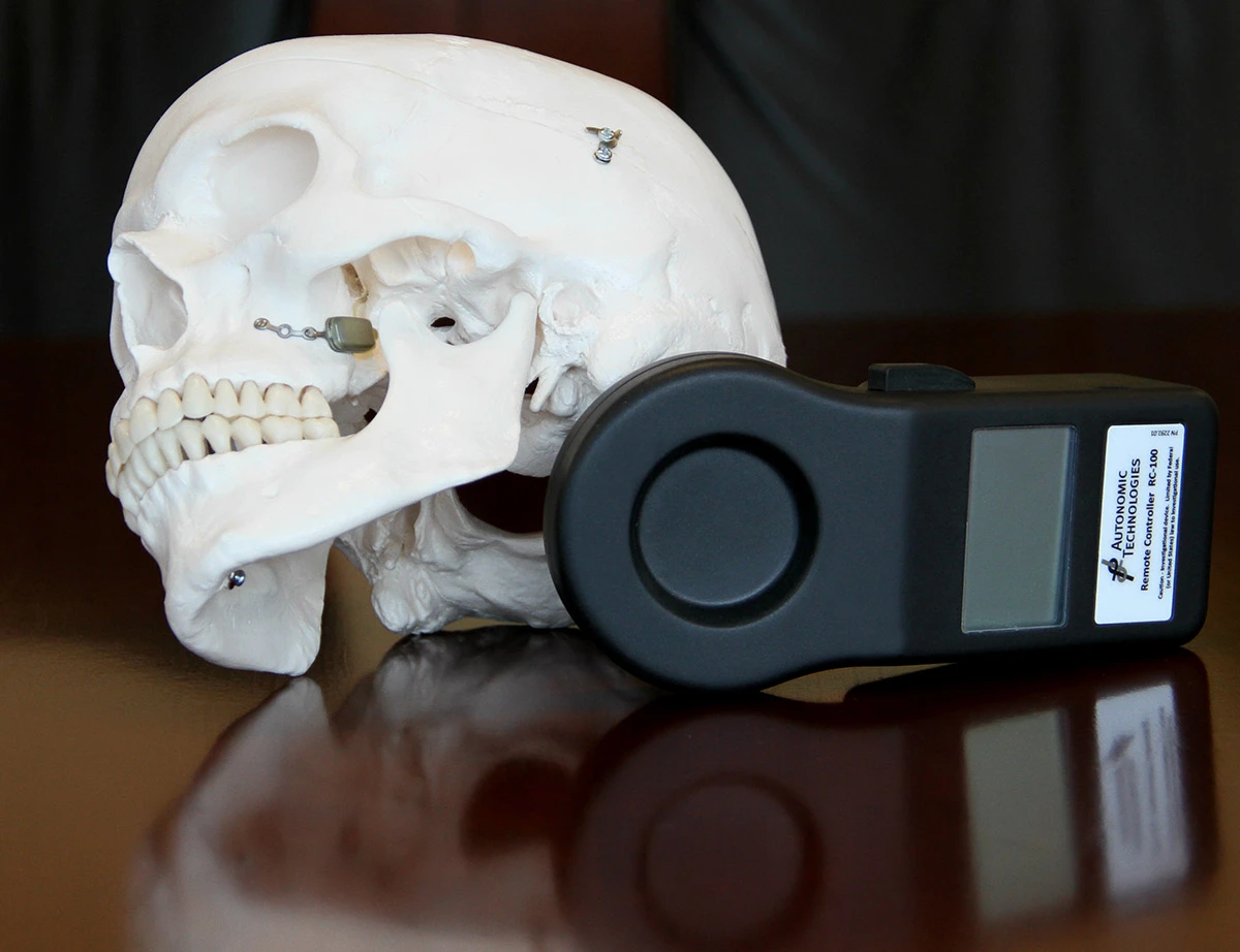 The ATI Neurostimulator (on skull, at left) and its handheld remote control (Photo: The Ohio State University)