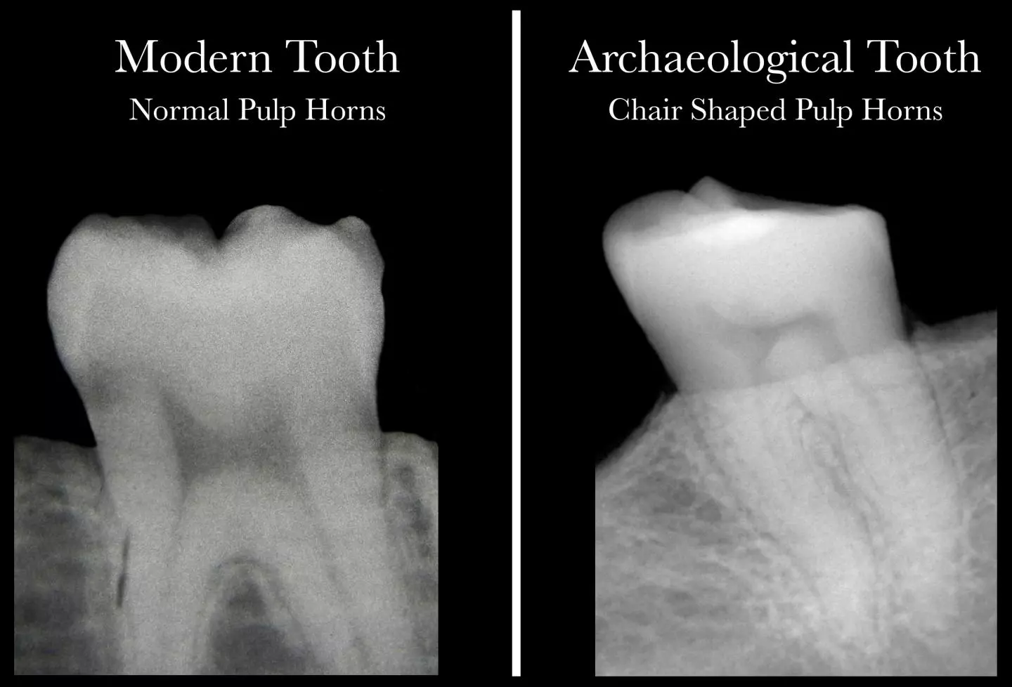 A modern healthy tooth with pulp "horns" (left), and an archeological tooth indicating a lack of vitamin D