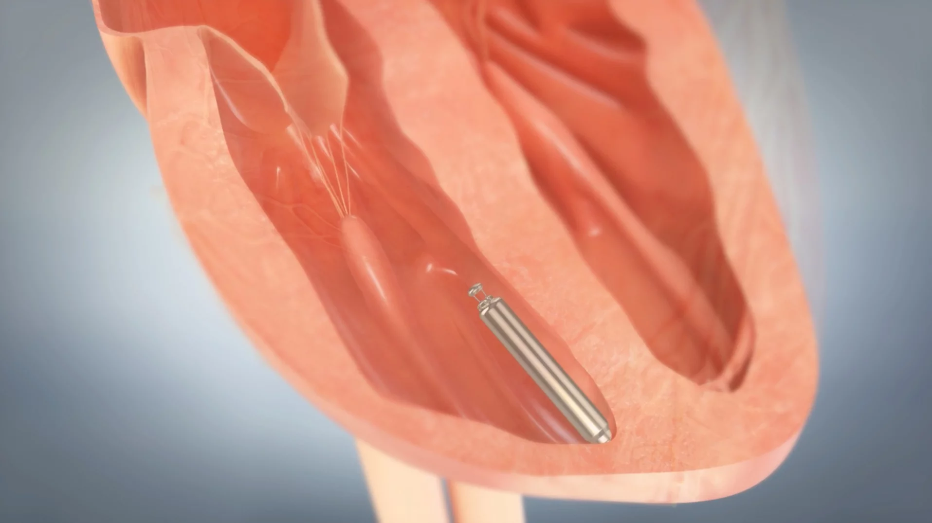 The Nanostim, in place within the heart