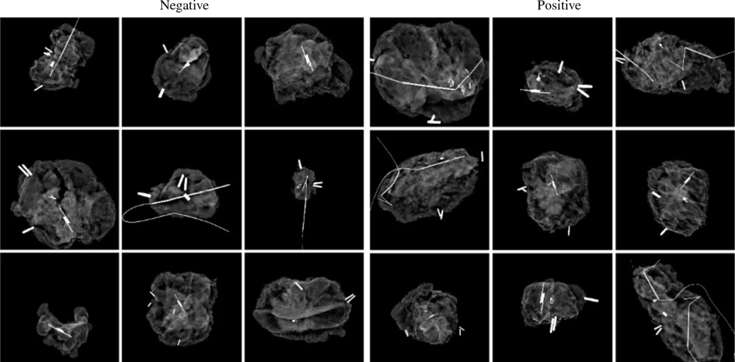 Examples of negative and positive specimen mammography images used to teach the AI model
