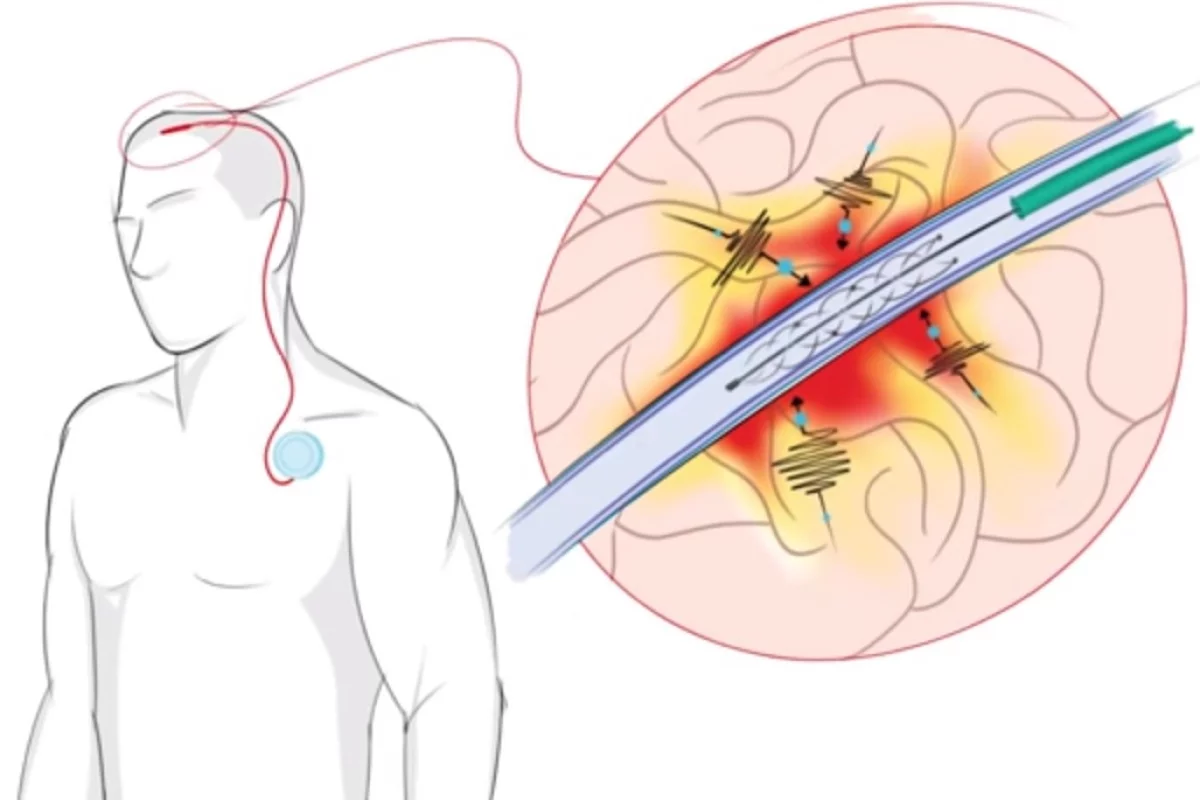 Medical researchers have produced a device capable of wirelessly controlling artificial limbs or an exoskeleton, and able to be implanted using a simple, relatively non-invasive procedure