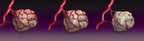 Illustration of Avastin's inhibition of blood vessel-growth to a cancer tumor (Image: Genentech)