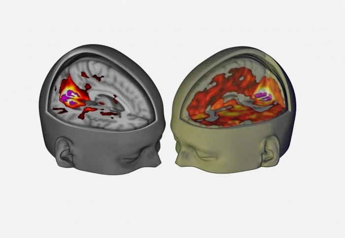 The brain image on the right shows the increase of brain areas contributing to visual processing under LSD, compared with the brain on the left under normal circumstances