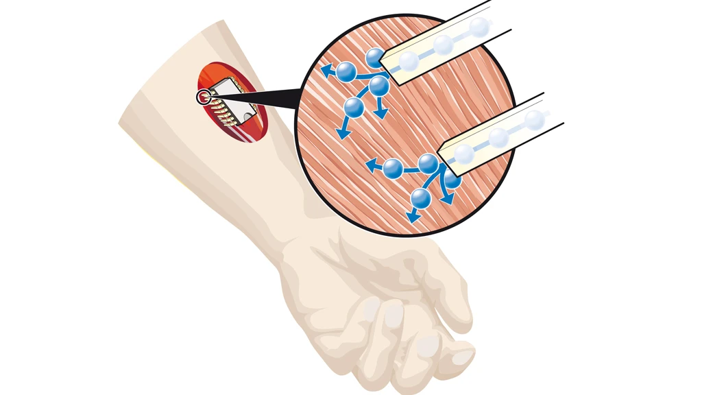 The new chemical chip can control the delivery of the neurotransmitter acetylcholine, enabling the chemical control of muscles in cases where the signaling system may not work for some reason