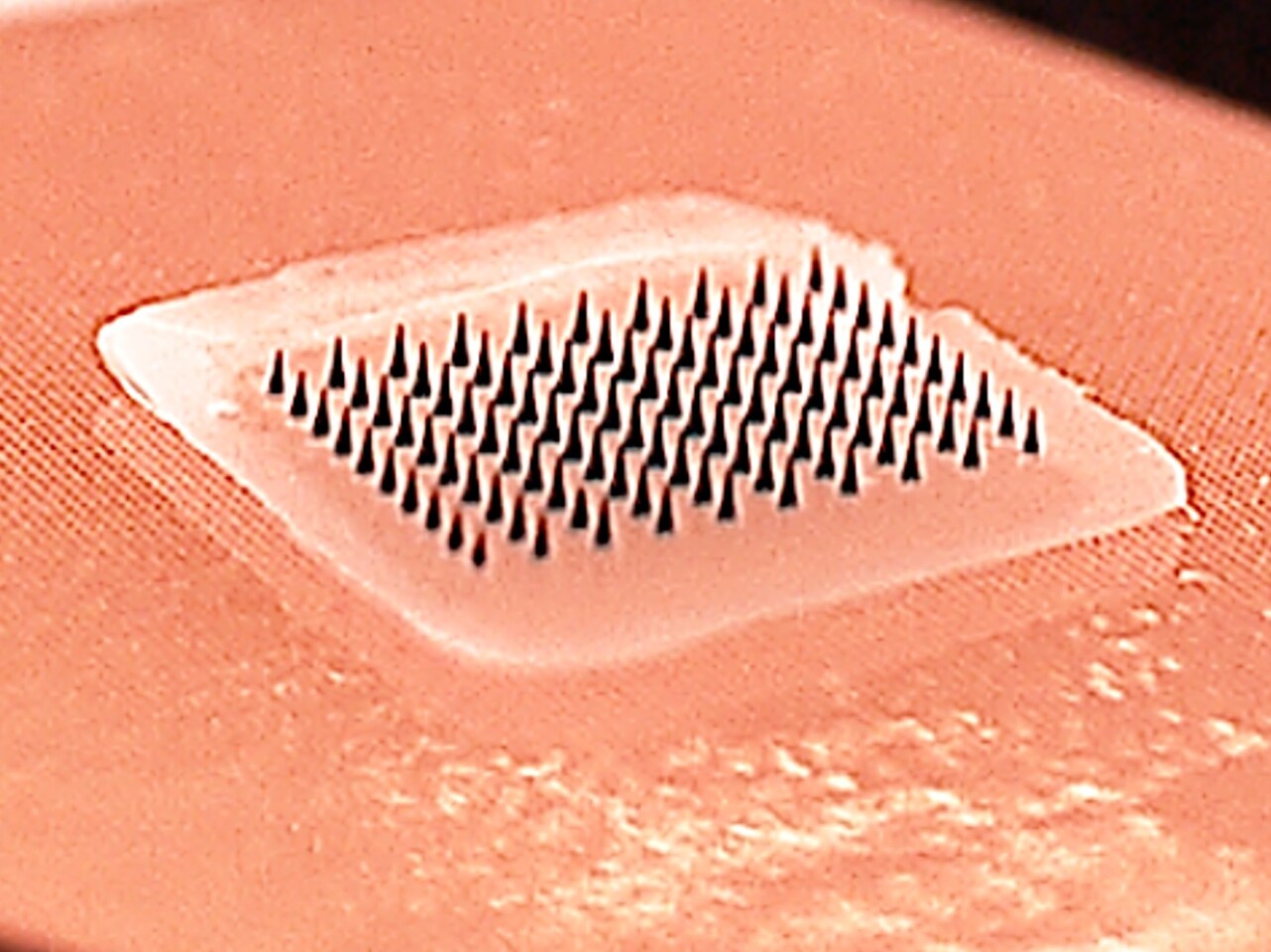 The microneedle patch contains an array of tiny plastic needles that dissolve in the skin, releasing the drug contained inside