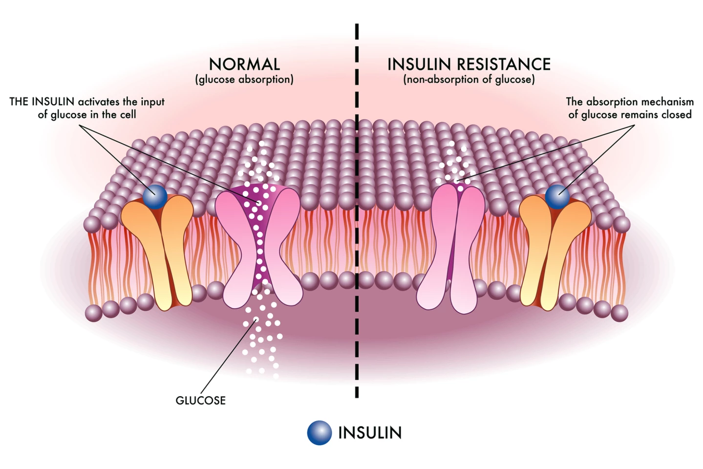 Insulin resistance is a feature of prediabetes