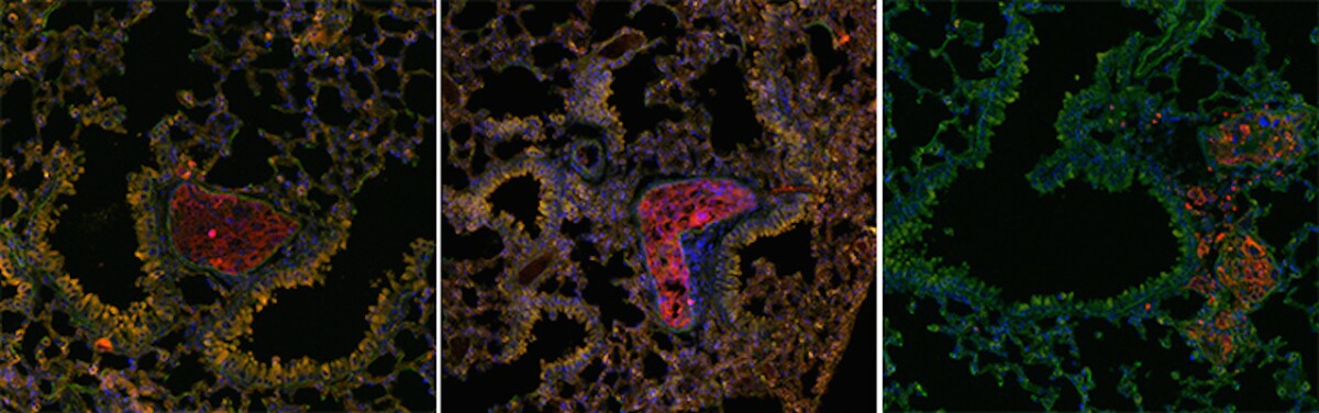 The red areas indicate breast cancer metastatic cells beginning to form in pre-metastatic niches in lung tissue