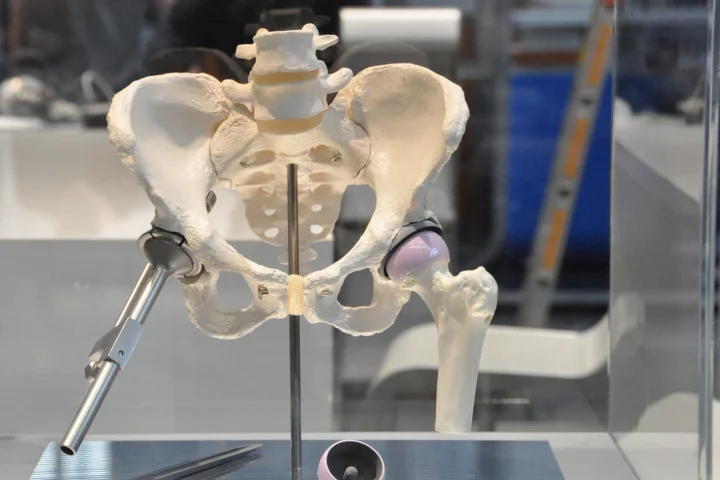 Fraunhofer's experimental new artificial hip (right)