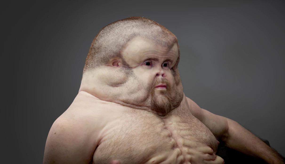 Graham's face is covered in fatty tissue
