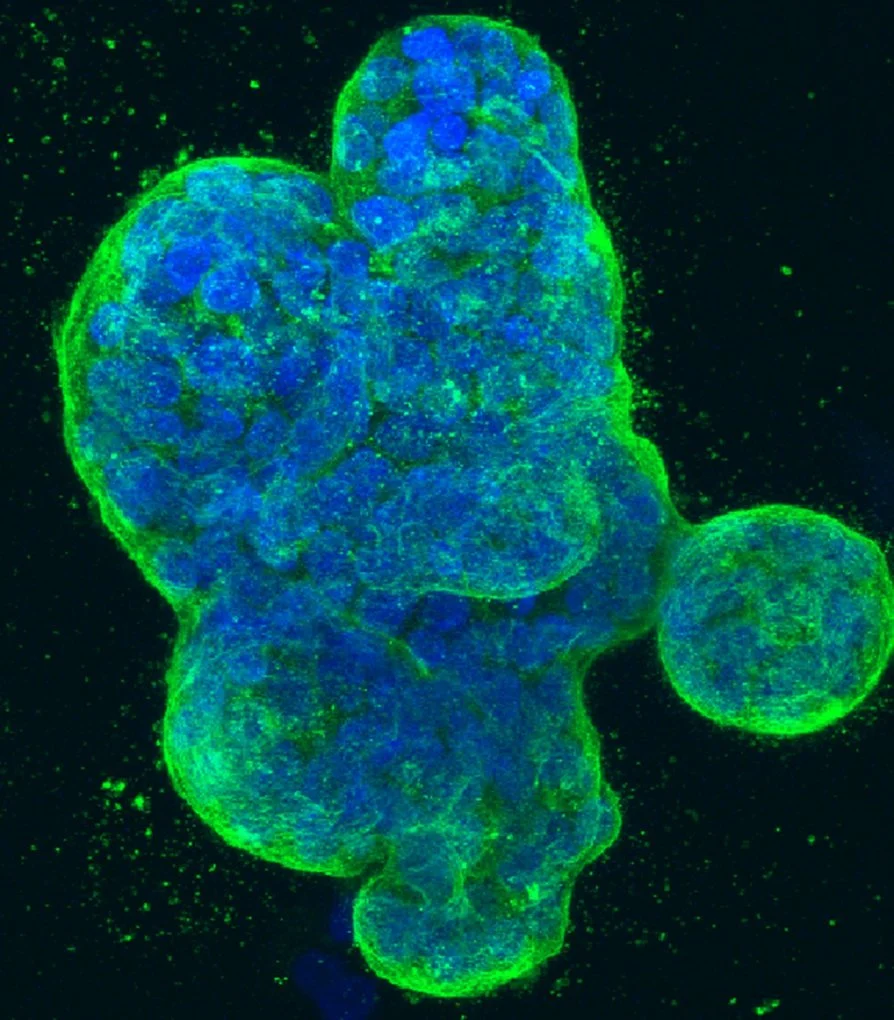A three-dimensional culture of human breast cancer cells