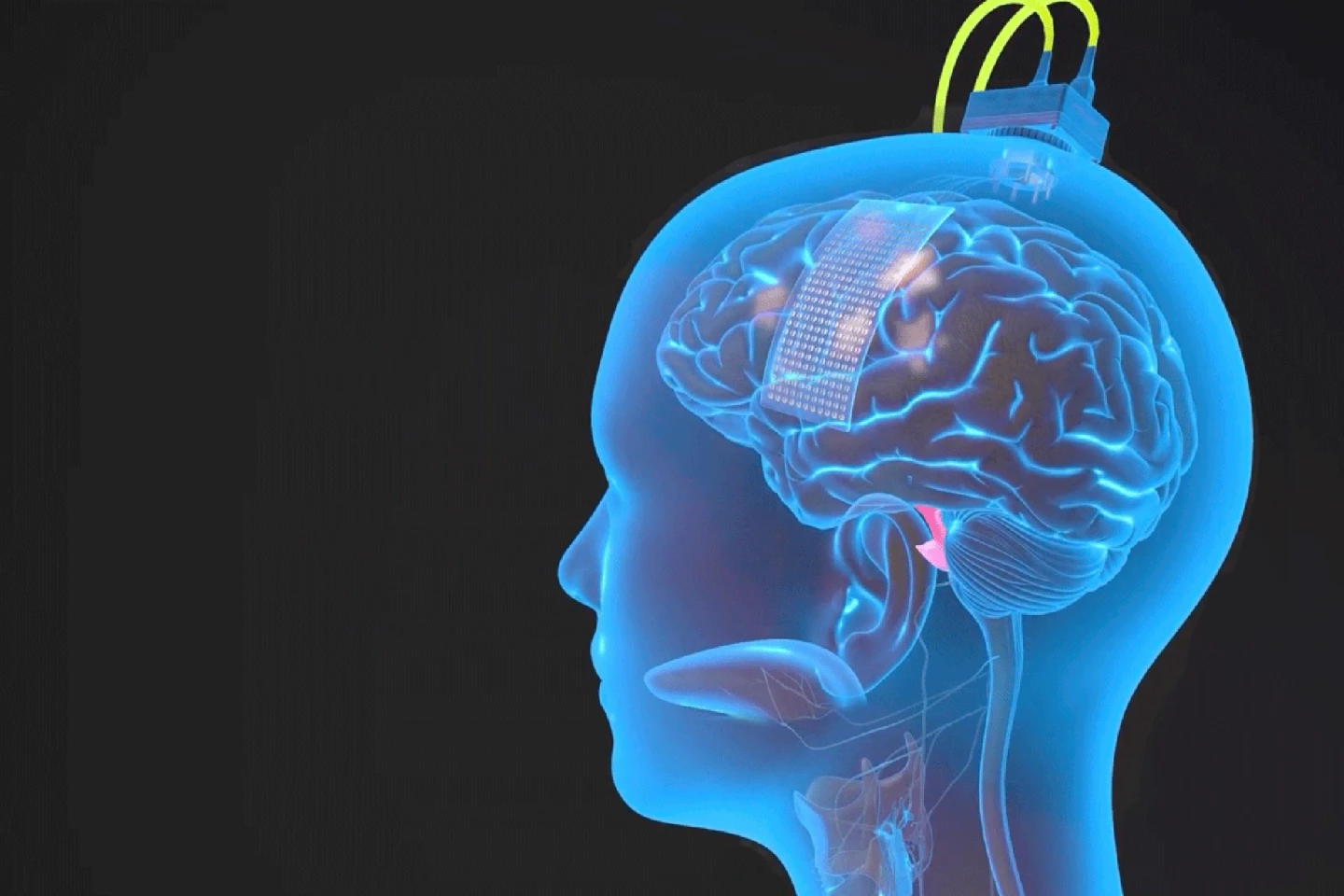 An illustration showing the surgically implanted electrodes on the surface of Ann's brain
