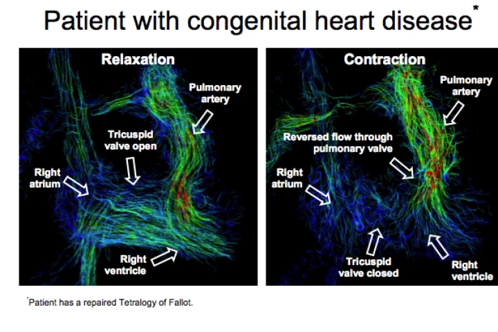 4D images show blood flow, direction and velocity and are markedly different in healthy volunteers when compared to patients with heart problems (Image: University of Wisconsin School of Medicine and Public Health)