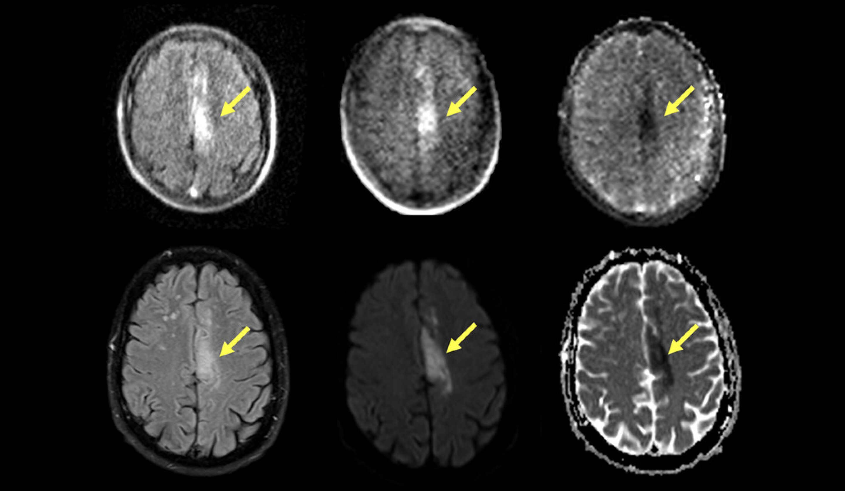 Portable MRI Can Accurately Detect Most Common Form Of Stroke portable-mri-can-accurately-detect-most-common-form-of-stroke