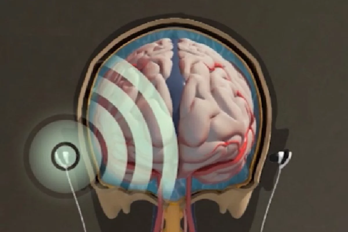 HeadSense says it has an alternative to invasive procedures to monitor pressure in the skull