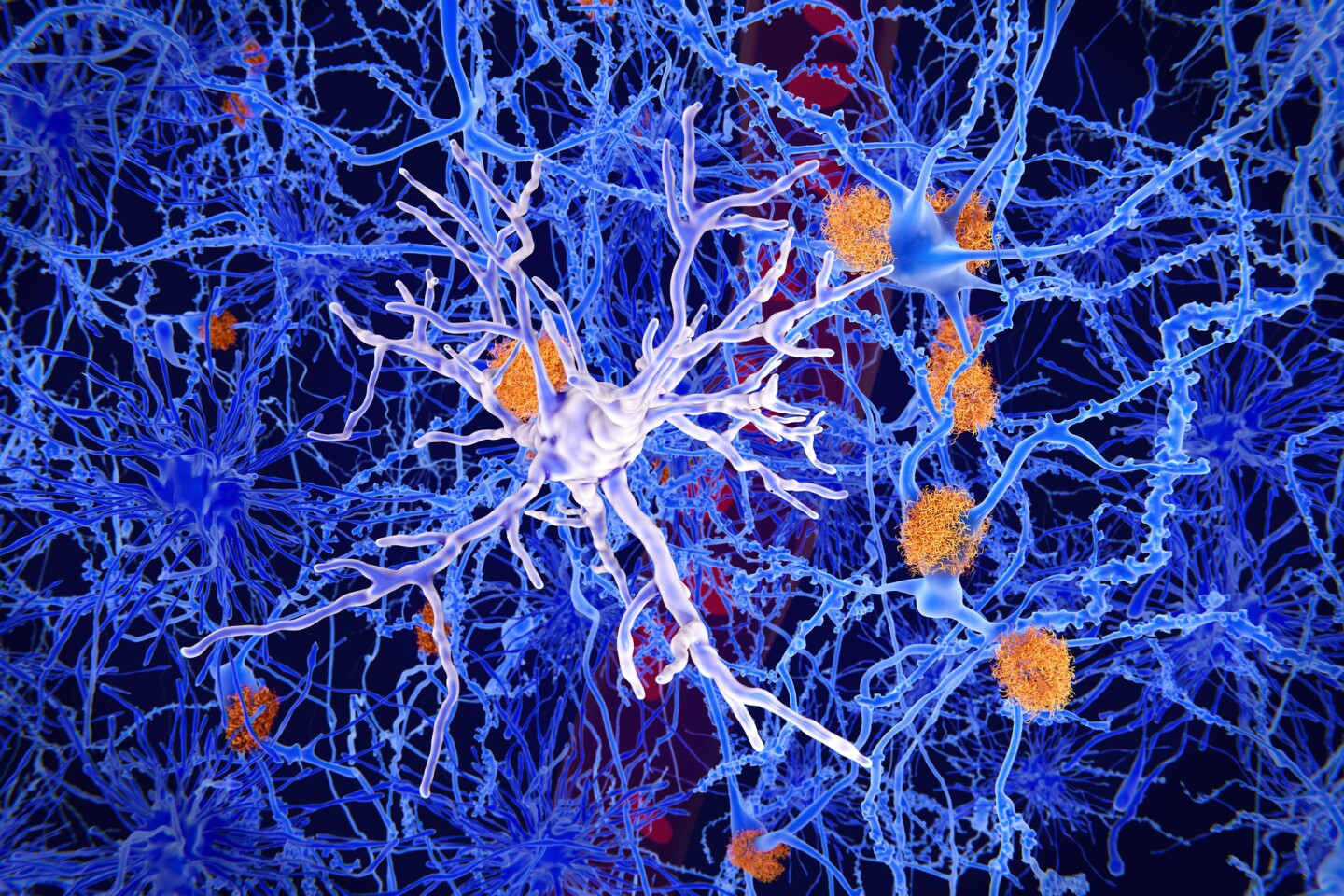 A study has linked genetic changes in the brain's immune cells to the neuroinflammation seen in Alzheimer's disease