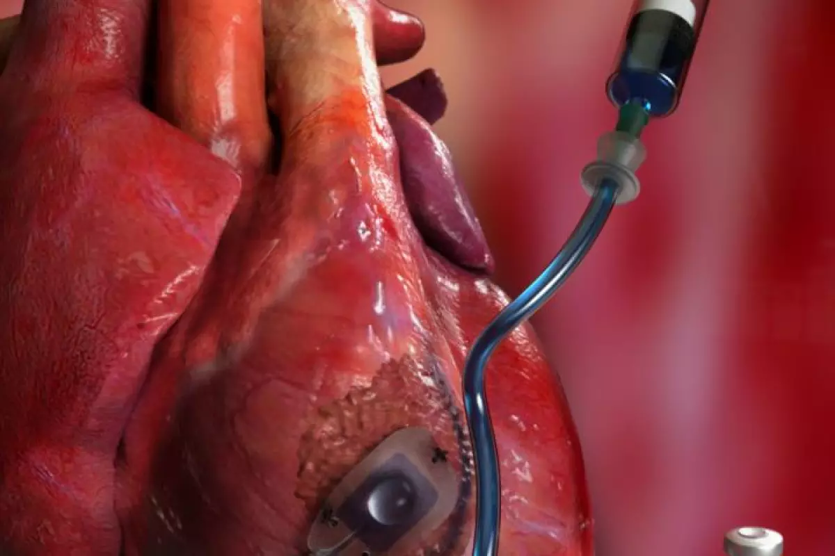 The Therepi medication-dispensing reservoir would be sutured onto the diseased heart tissue