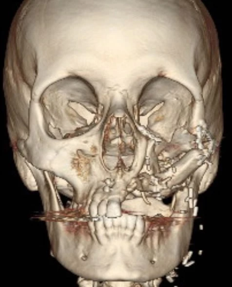 S. Bell: skull structure following free-flap surgery