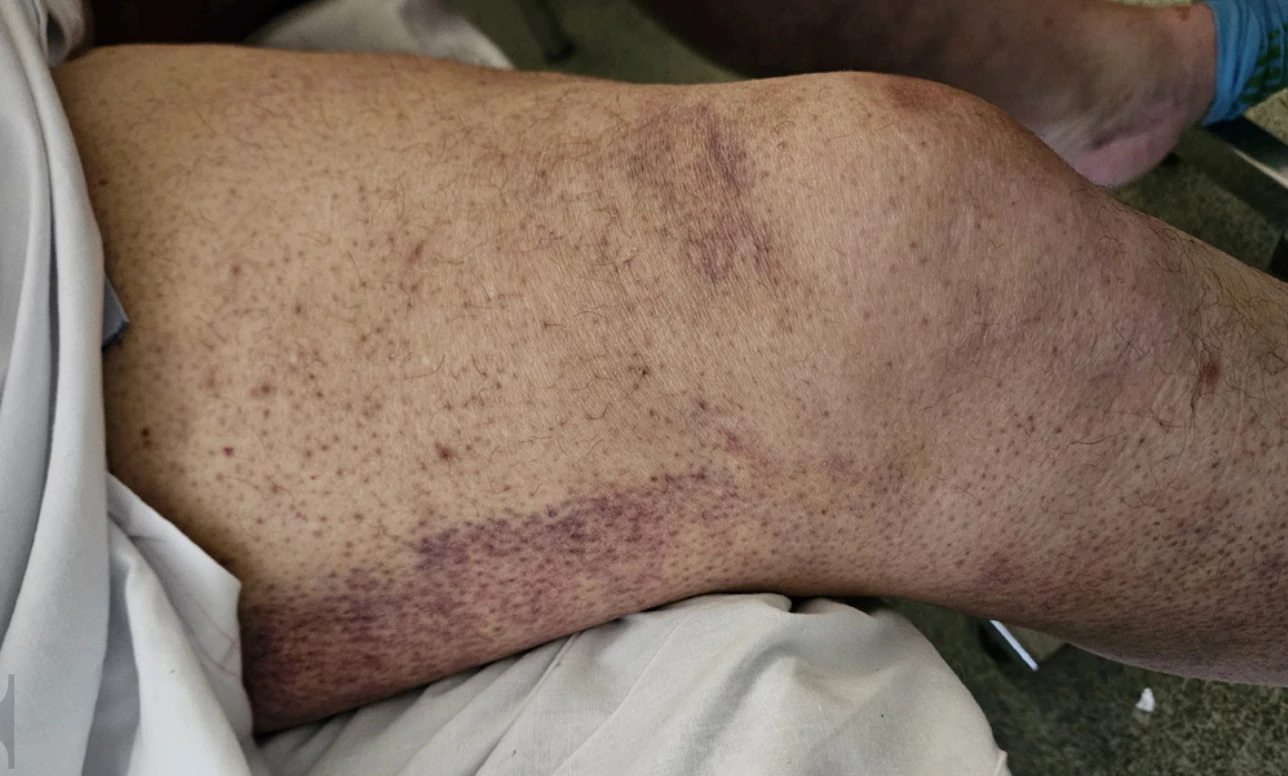 The signs of scurvy that were initially missed by medical staff