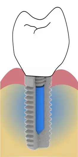 Once the implant has been screwed into the bone, the solution will begin to slowly diffuse out, keeping biofilms from forming at the screw/bone interface
