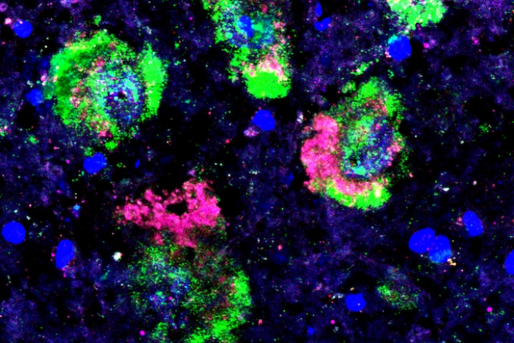 Dopamine-producing neurons can be seen in green within brain tissue samples from patients who died from Parkinson's disease