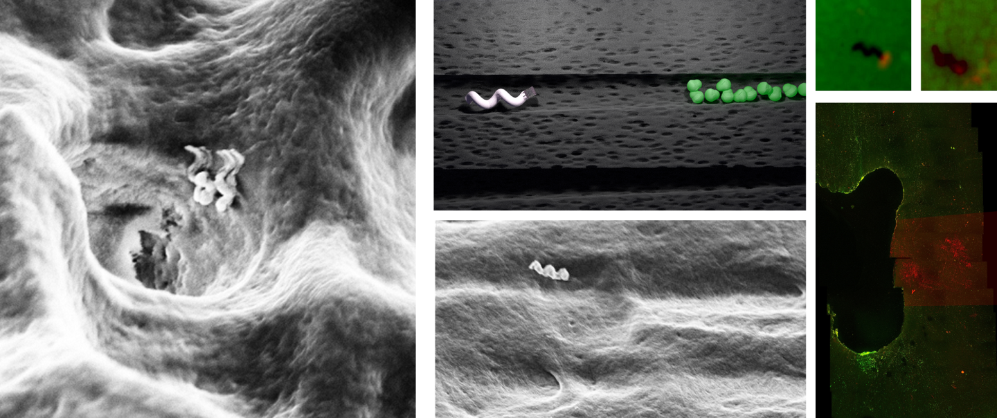 Images and schematics showing tiny nanobots moving through dentinal tubules to take out bacteria