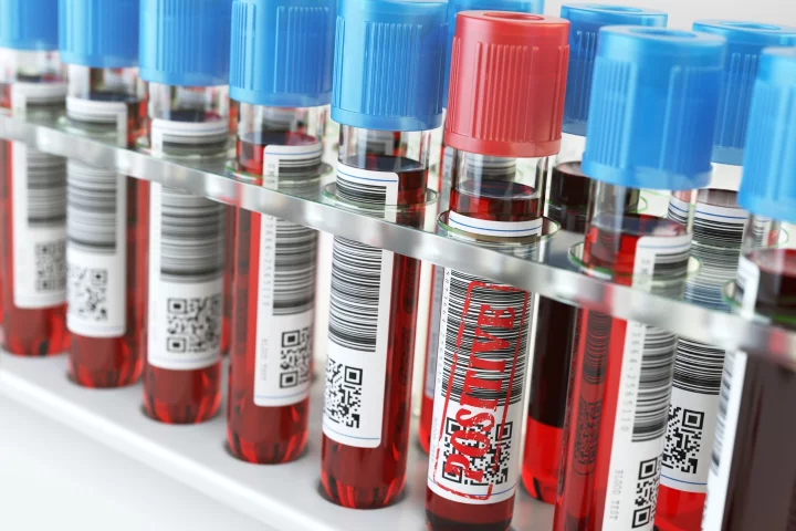 Doctors may soon be able to identify sufferers of chronic fatigue syndrome using a blood test