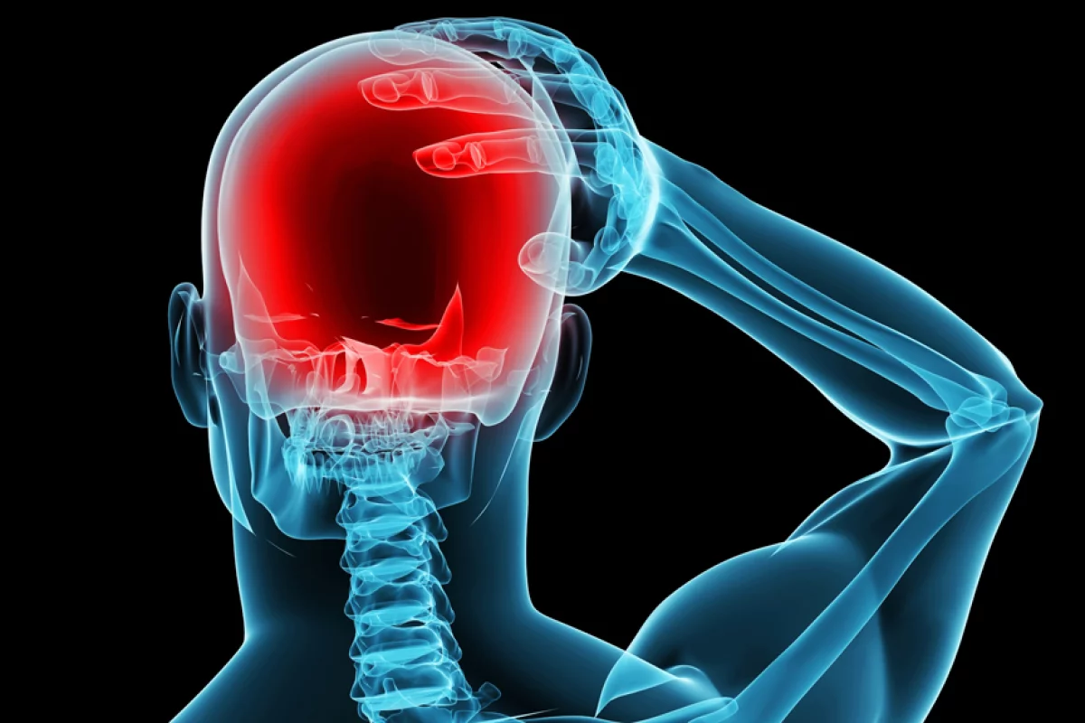 A new study has shown that transcranial direct current stimulation (tDCS) can prevent migraines from occurring (Image: Shutterstock)