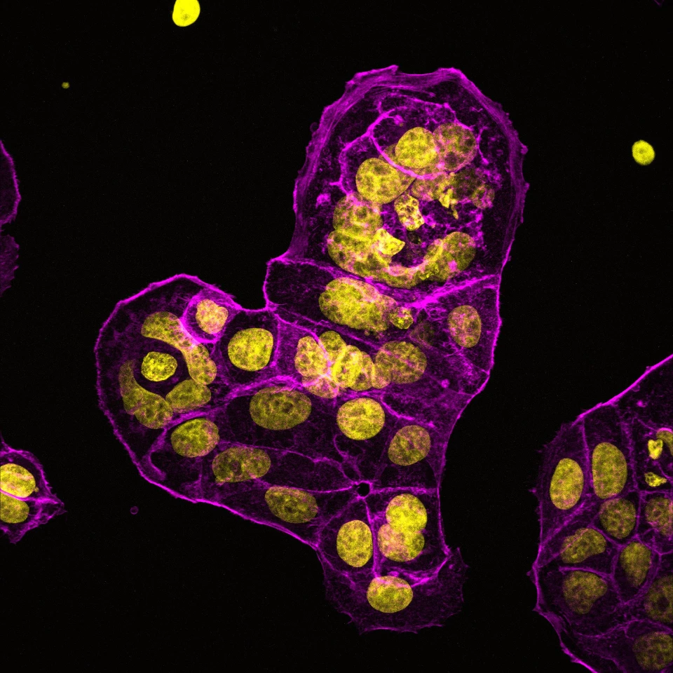 "Close to My Heart," an image of breast cancer tumor cells growing in a dish, took second place