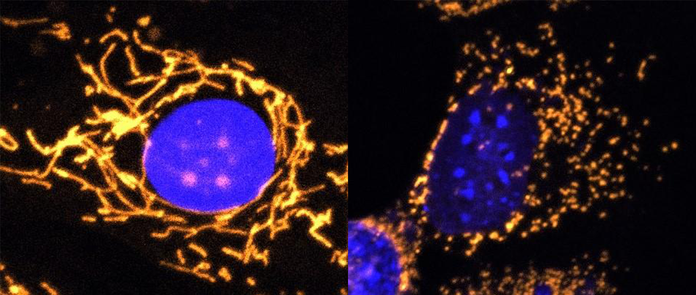 Gene Therapy May Help Prevent Vision Loss From Genetic Eye Disease