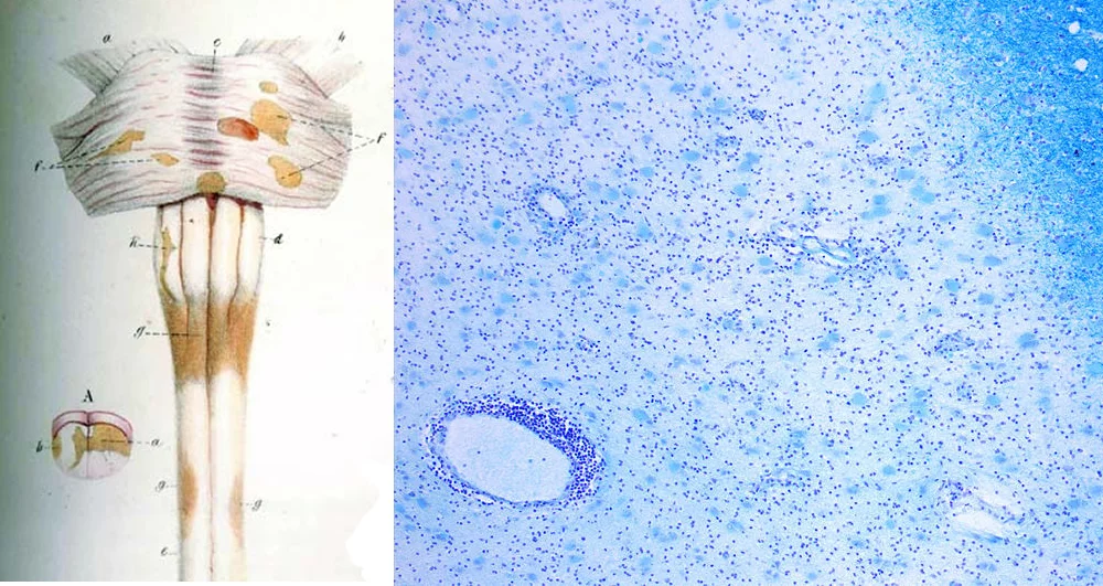 Left: diagram from a medical text showing how MS affects the myelin sheathing of nerves. Right: MS lesions under a microscope.