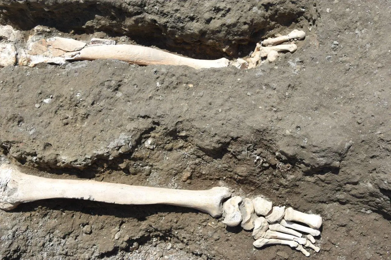 Lesions were found on the tibia, indicating the man was suffering from a bone infection