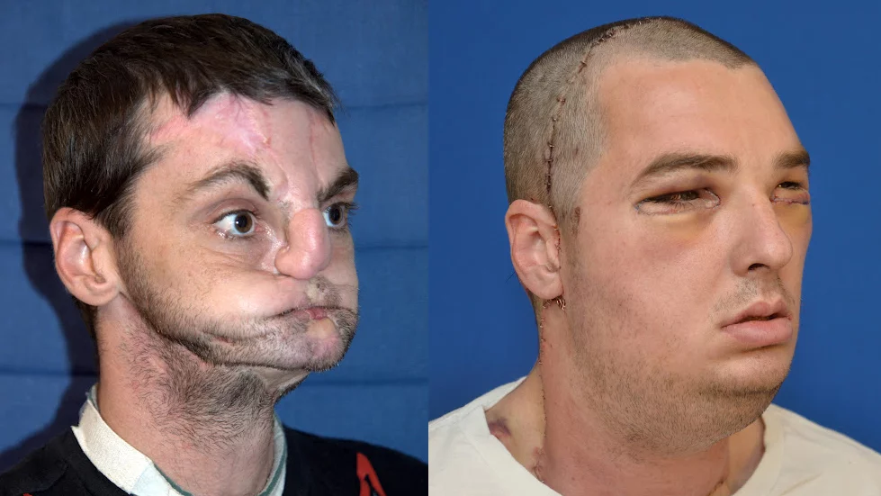 Remarkable transformation - before and after shots of the face transplant recipient (Photo: University of Maryland Medical Center)