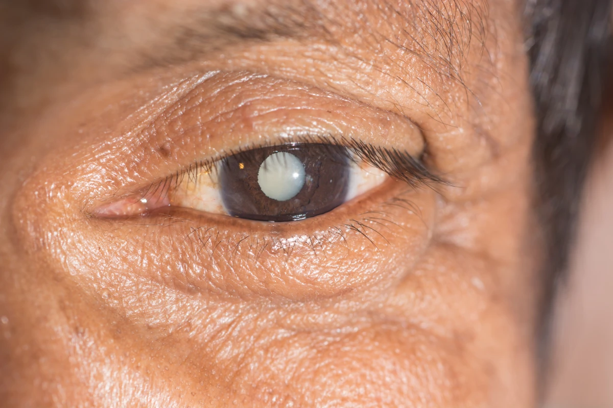 Research suggests that treating cataracts by way of an eye drop mightn't be all that far away
