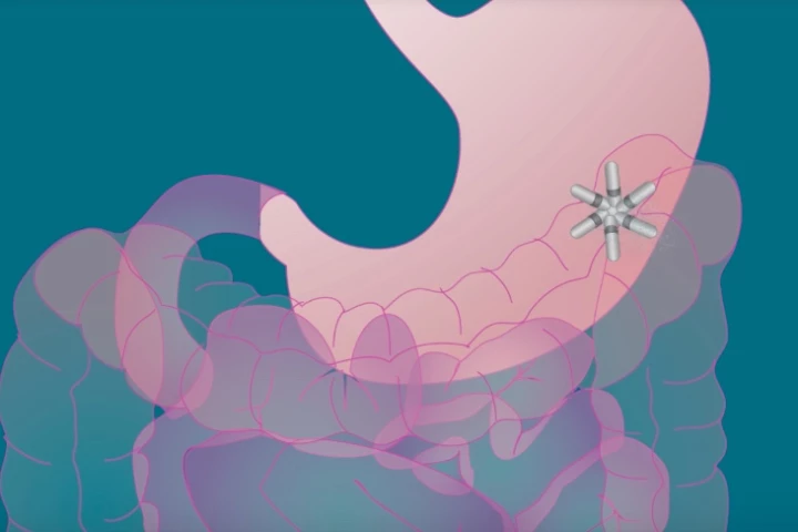 The Lyndra capsule opens into a star shape upon reaching the stomach