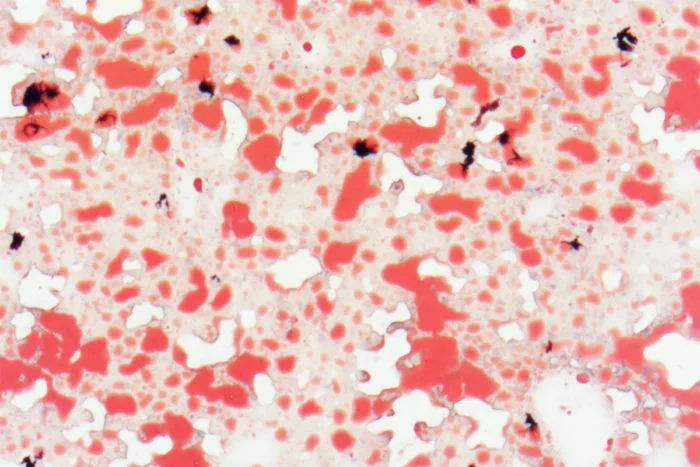 An image of the livers of mice fed a high-fat diet, showing many fatty deposits (red) – new research may have found a natural sugar that can reduce these build-ups and treat metabolic syndrome