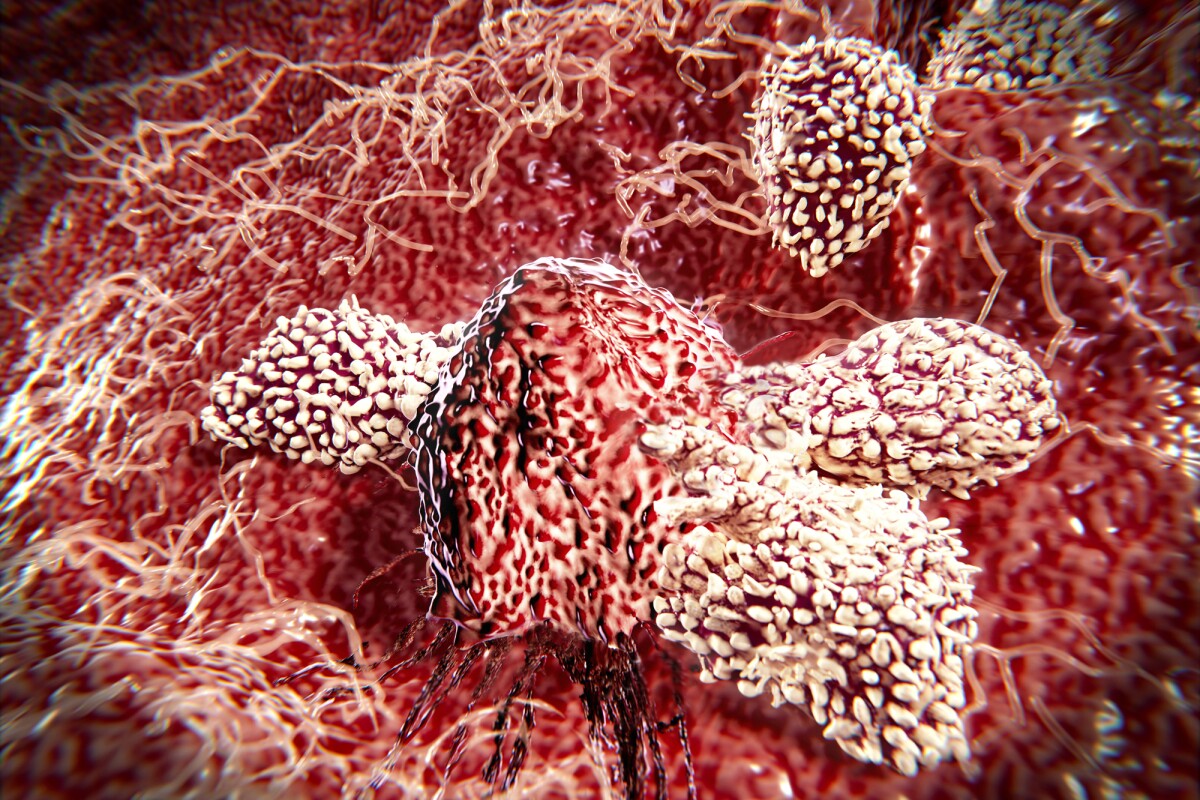 New insight into aggressive breast cancers - News - Cardiff University